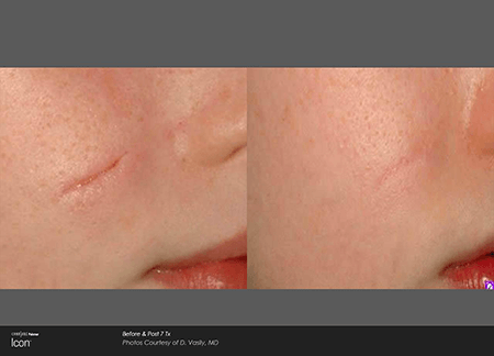 Laser Scar and Stretch Mark Treatments